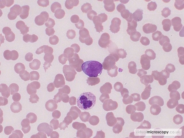 Blast with Auer Rods - Acute Myeloid Leukaemia with Eosinophilia (Inversion 16)