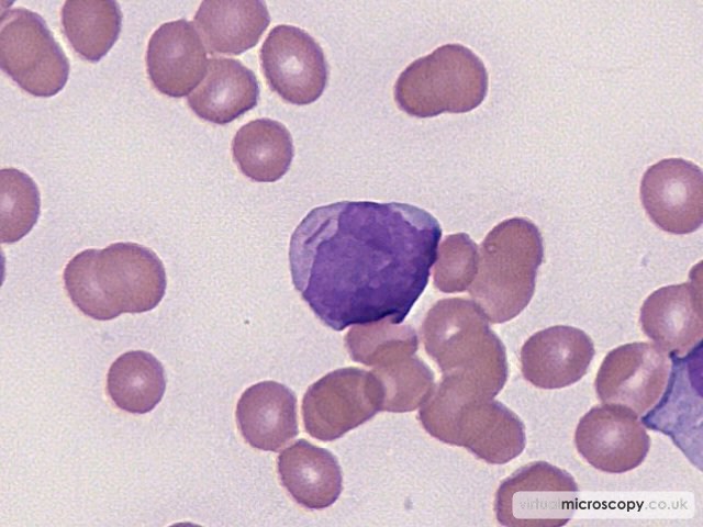 Auer Rod - Acute Monoblastic Leukaemia with Auer rods