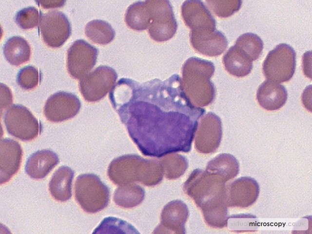 Promonocyte - Acute Monoblastic Leukaemia with Auer rods