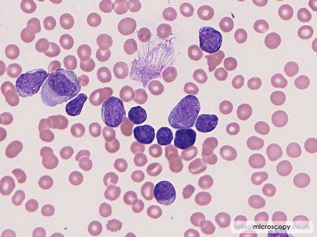 Mixed Population of Leukaemic Blasts - B cell Acute Lymphoblastic Leukaemia