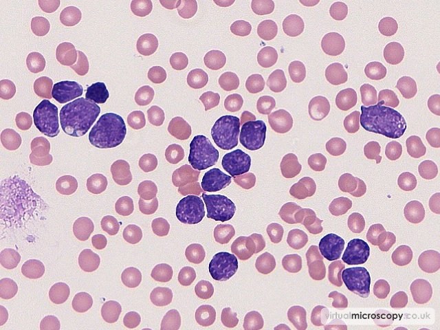 Monomorphic Small Blasts - B cell Acute Lymphoblastic Leukaemia