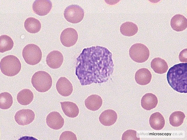 Smear Cell - B cell Acute Lymphoblastic Leukaemia