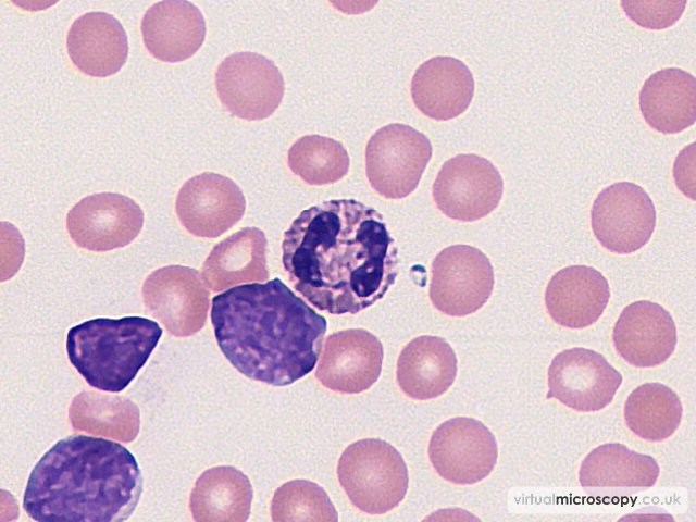Normal Neutrophil - B cell Acute Lymphoblastic Leukaemia