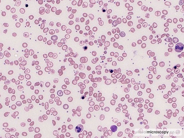 nRBC - Beta Thalassaemia Major