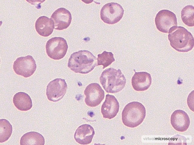 Abnormal Haemoglobinisation - Beta Thalassaemia Major