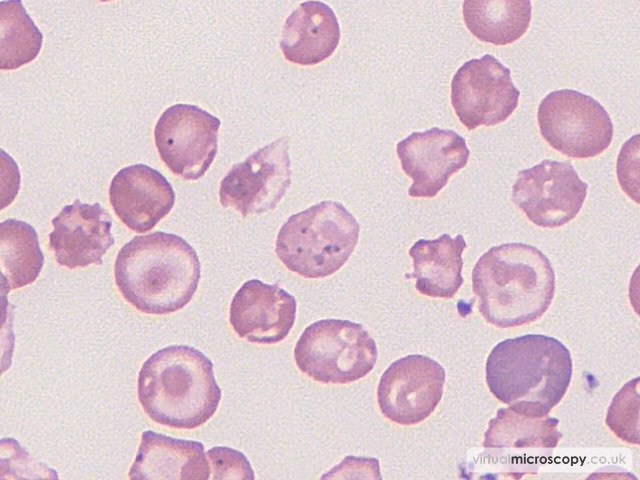 Pappenheimer bodies - Beta Thalassaemia Major