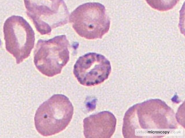 Basophillic Stippling - Beta Thalassaemia Major