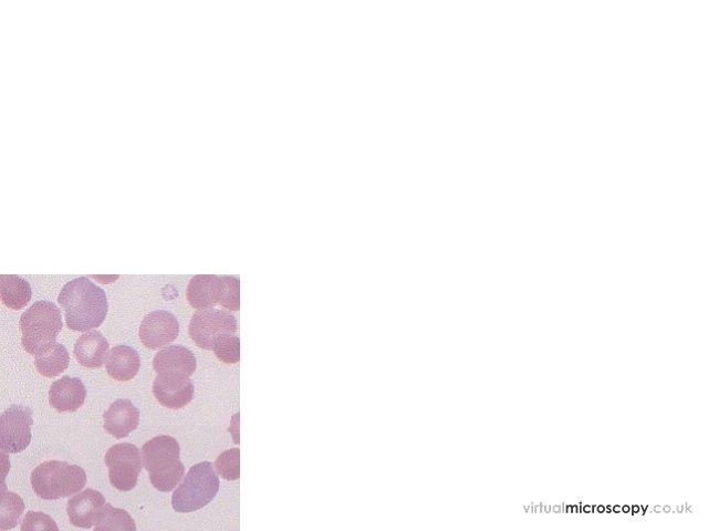 Hypogranular Neutrophils - Acute Myeloid Leukaemia with Eosinophilia (Inversion 16)