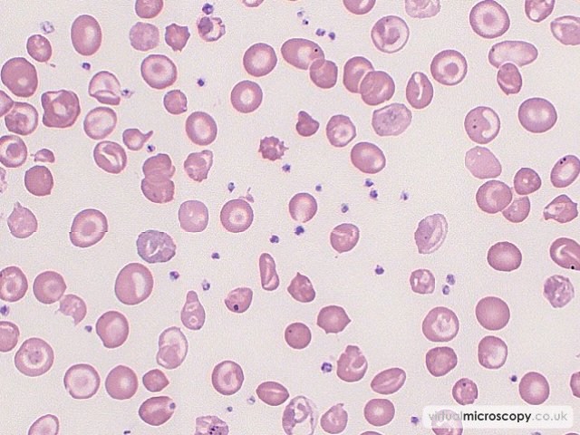 Mild thrombocytosis - Beta Thalassaemia Major