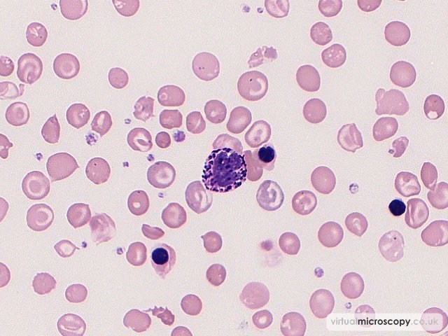Basophil - Beta Thalassaemia Major