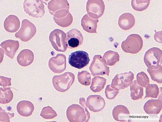Normal Lymphoicyte - Beta Thalassaemia Major