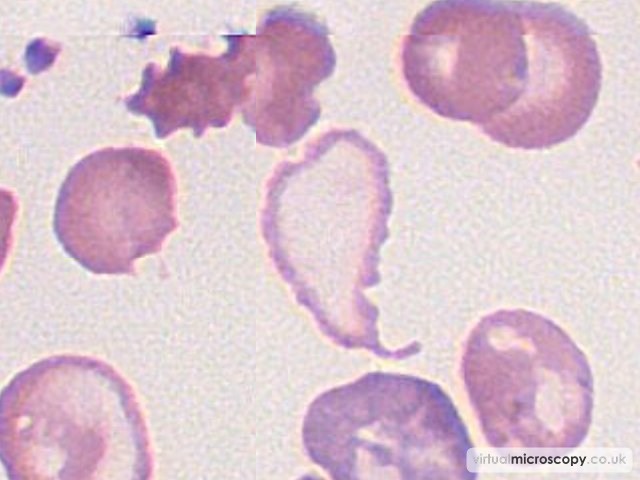 Hypochromia - Beta Thalassaemia Major