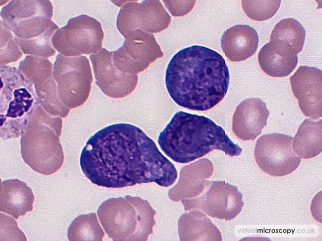Plasmablasts - Plasmablastic Lymphoma and Multicentric Castlemans Disease