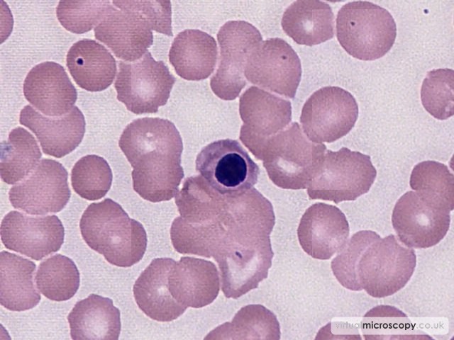 Nucleated RBC - Plasmablastic Lymphoma and Multicentric Castlemans Disease