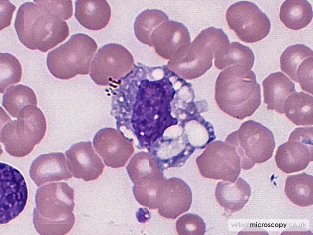 Reactive Mooncyte - Plasmablastic Lymphoma and Multicentric Castlemans Disease