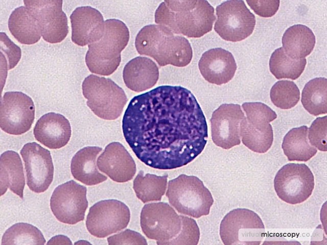 Lymphoid Blast - Plasmablastic Lymphoma and Multicentric Castlemans Disease