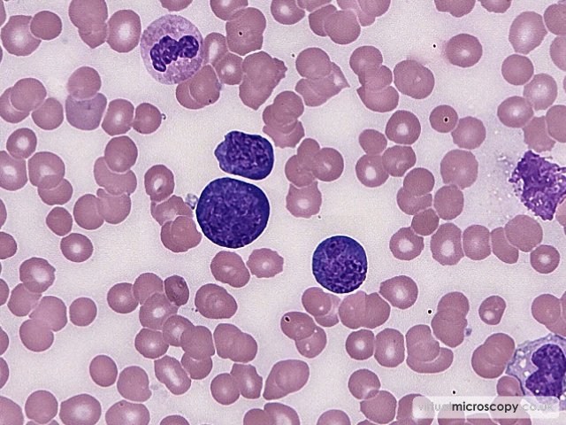 Plasmablasts - Plasmablastic Lymphoma and Multicentric Castlemans Disease
