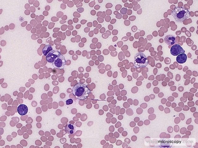 Reactive Monocytes - Plasmablastic Lymphoma and Multicentric Castlemans Disease