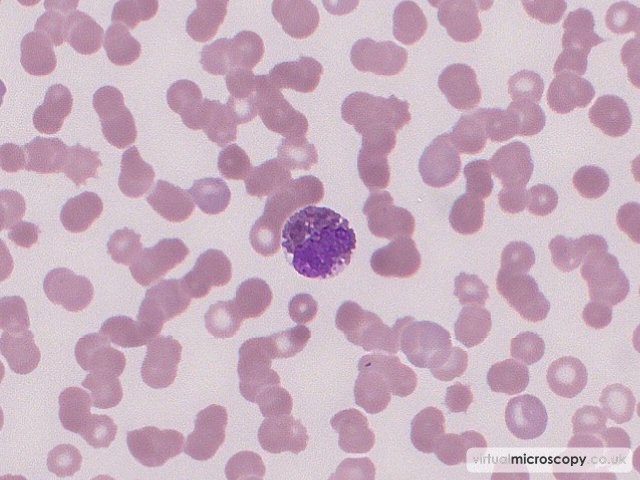 Abnormal Basophil - Acute Myeloid Leukaemia with Eosinophilia (Inversion 16)