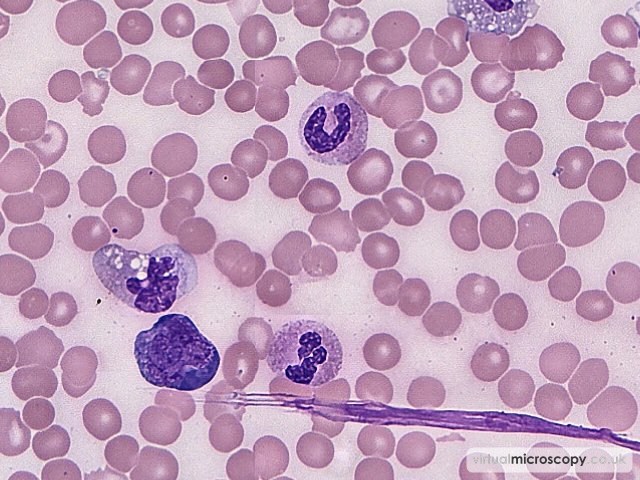 Reactive Neutrophils - Plasmablastic Lymphoma and Multicentric Castlemans Disease