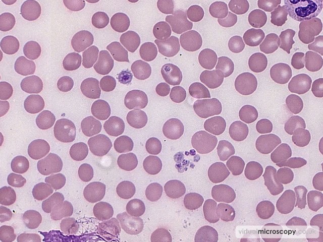 Platelet Anisocytosis and Clump - Plasmablastic Lymphoma and Multicentric Castlemans Disease