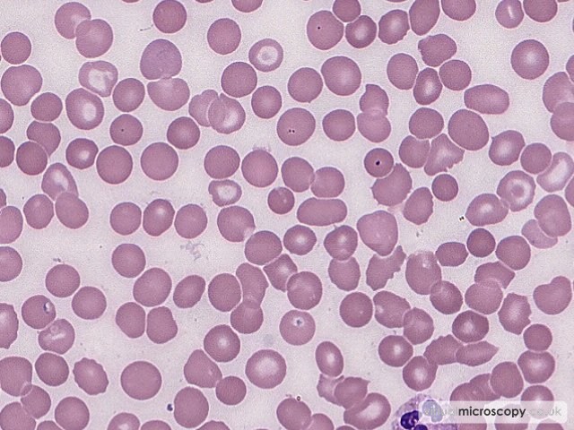 Mild Red Cell Anisopoikilocytosis - Plasmablastic Lymphoma and Multicentric Castlemans Disease
