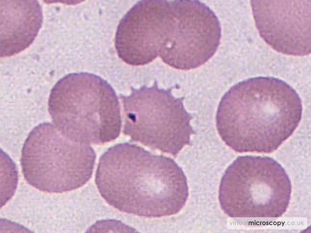 Acanthocyte - Plasmablastic Lymphoma and Multicentric Castlemans Disease