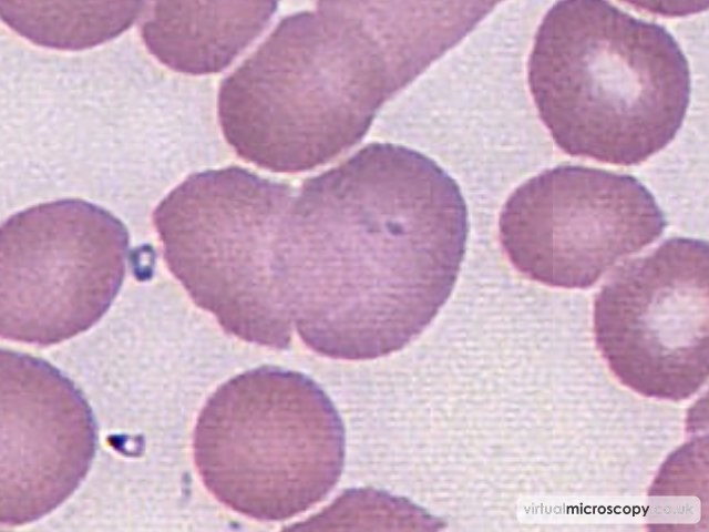Reticulocyte with Pappenheimer bodies - Plasmablastic Lymphoma and Multicentric Castlemans Disease