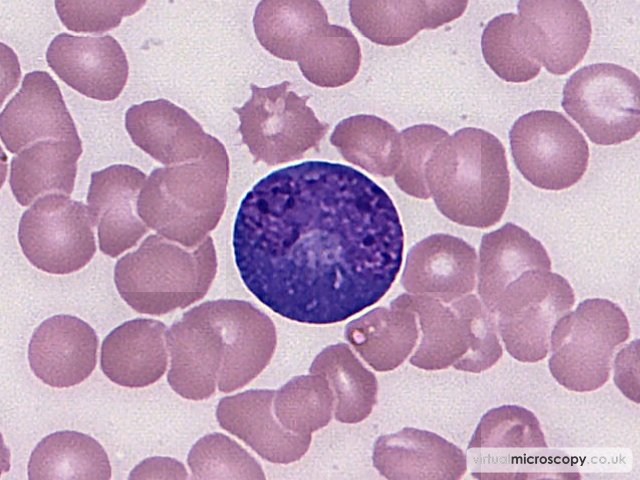 Plasmablast with Prominent Golgi zone - Plasmablastic Lymphoma and Multicentric Castlemans Disease
