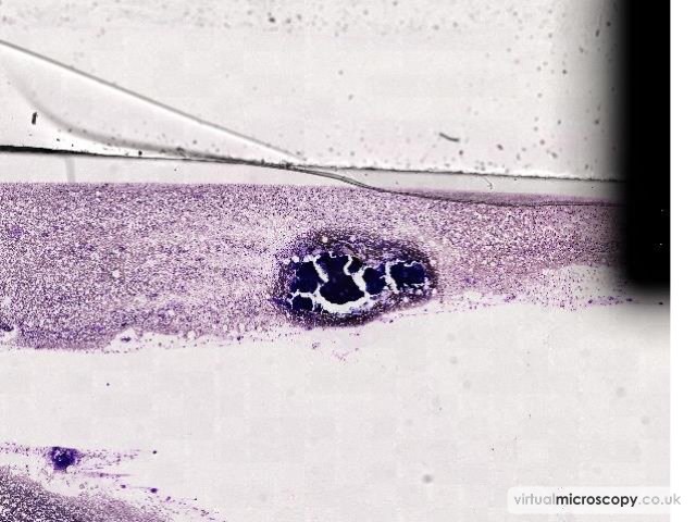 Particle - Myelodysplasia with Monosomy 7