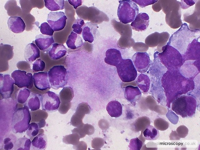 Megakaryocyte - Myelodysplasia with Monosomy 7