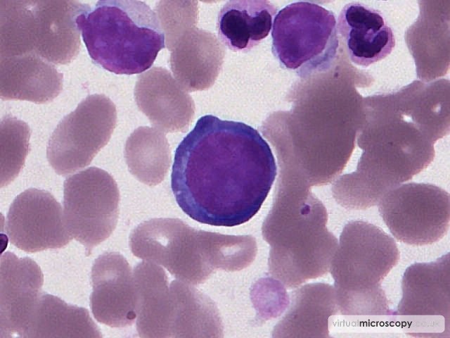 Basophillic erythroblast - Myelodysplasia with Monosomy 7