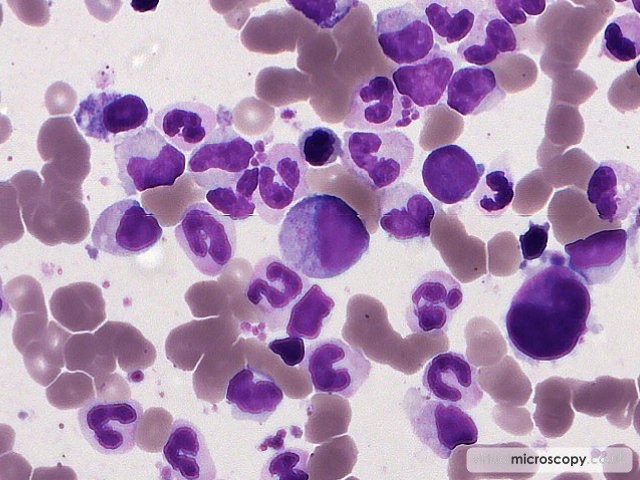 Myelocyte - Myelodysplasia with Monosomy 7