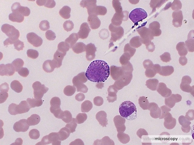 Eosinophil Myelocyte - Acute Myeloid Leukaemia with Eosinophilia (Inversion 16)