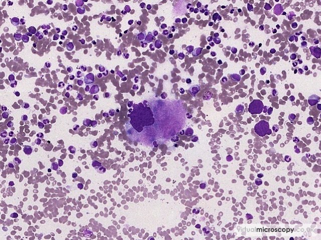 Normal Megakaryocyte - Myelodysplasia with Monosomy 7