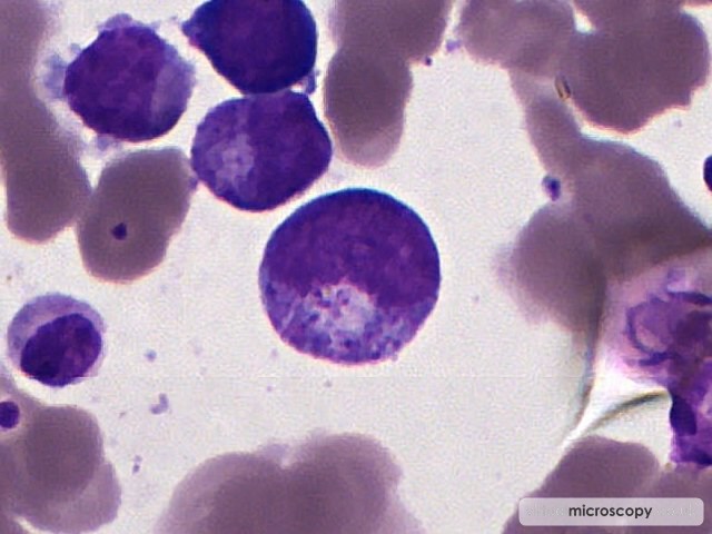 Promyelocyte - Myelodysplasia with Monosomy 7