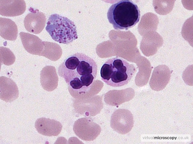 Hypogranular Neutrophils - Myelodysplasia with Monosomy 7