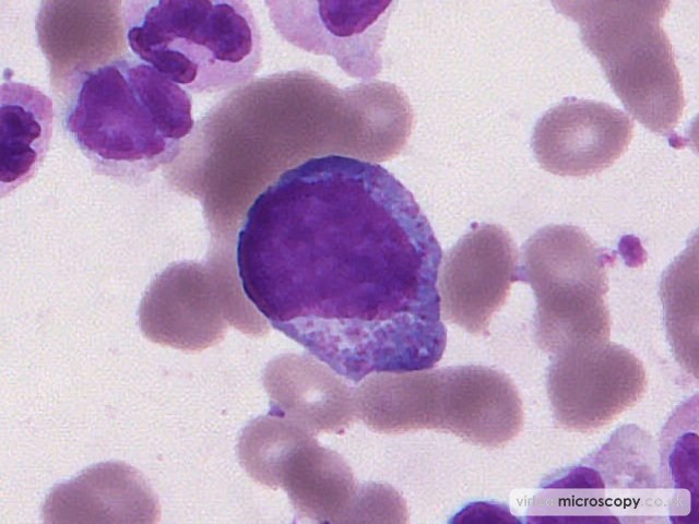 Myeloid Blast - Myelodysplasia with Monosomy 7