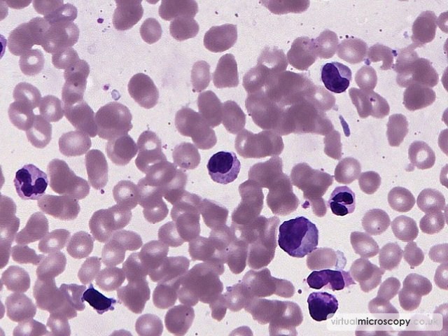 Ragged Nucleus - Myelodysplasia with Monosomy 7