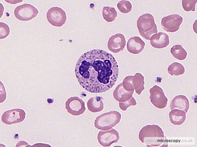 Normal Neutrophil - Hb C trait plus alpha thal trait plus iron deficiency