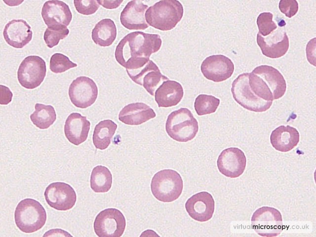 C crystals - Hb C trait plus alpha thal trait plus iron deficiency