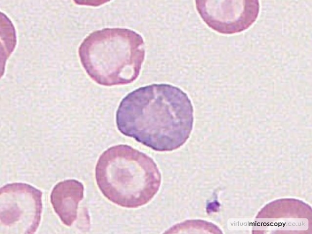Reticulocyte - Hb C trait plus alpha thal trait plus iron deficiency