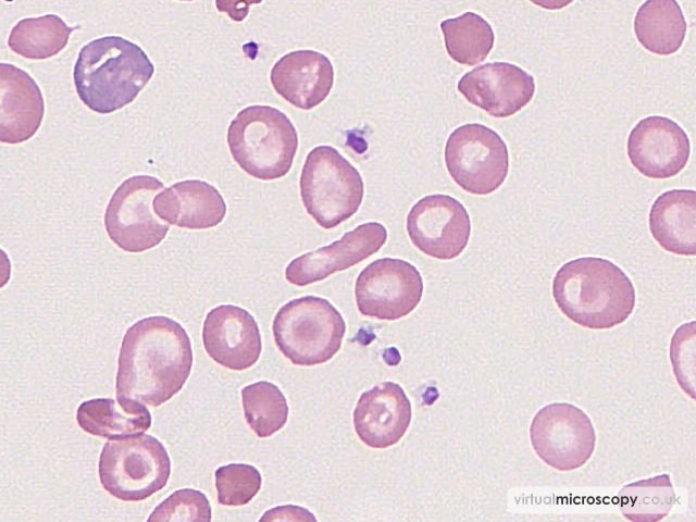 Pencil Cell - Hb C trait plus alpha thal trait plus iron deficiency