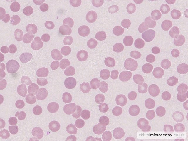 Red Cell Anisocytosis - Acute Myeloid Leukaemia with Eosinophilia (Inversion 16)