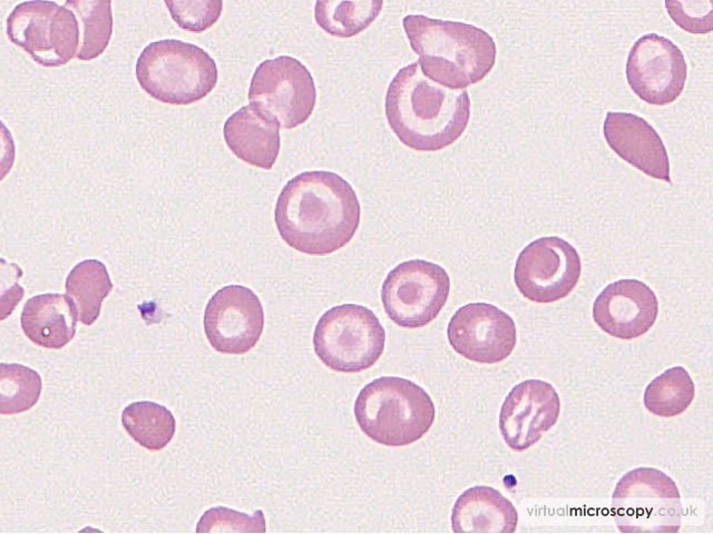 Target Cells - Hb C trait plus alpha thal trait plus iron deficiency