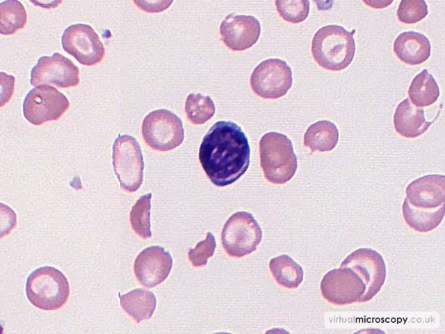 Normal Lymphocyte - Hb C trait plus alpha thal trait plus iron deficiency