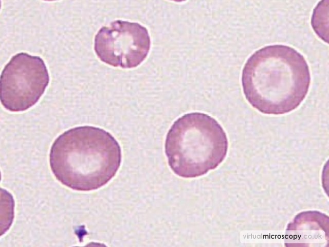 Anisochromasia - Hb C trait plus alpha thal trait plus iron deficiency