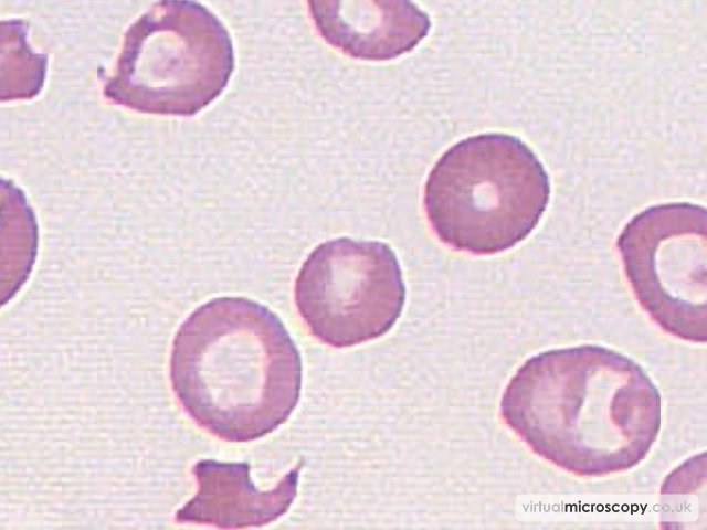 Anisochromasia II - Hb C trait plus alpha thal trait plus iron deficiency
