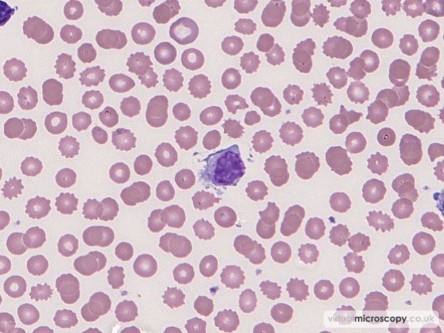 lymphocyte with polar villi - Splenic Marginal Zone Lymphoma