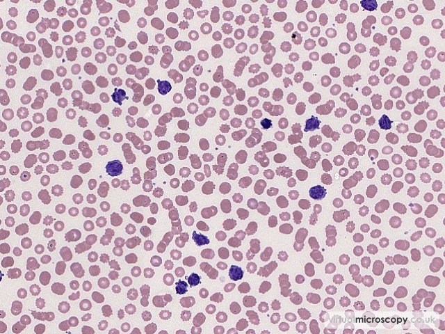 Abnormal Lymphocytes - Splenic Marginal Zone Lymphoma